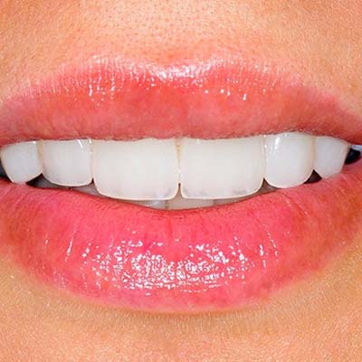 veneers Schöne Zähne mit Keramikplättchen (Veneers)